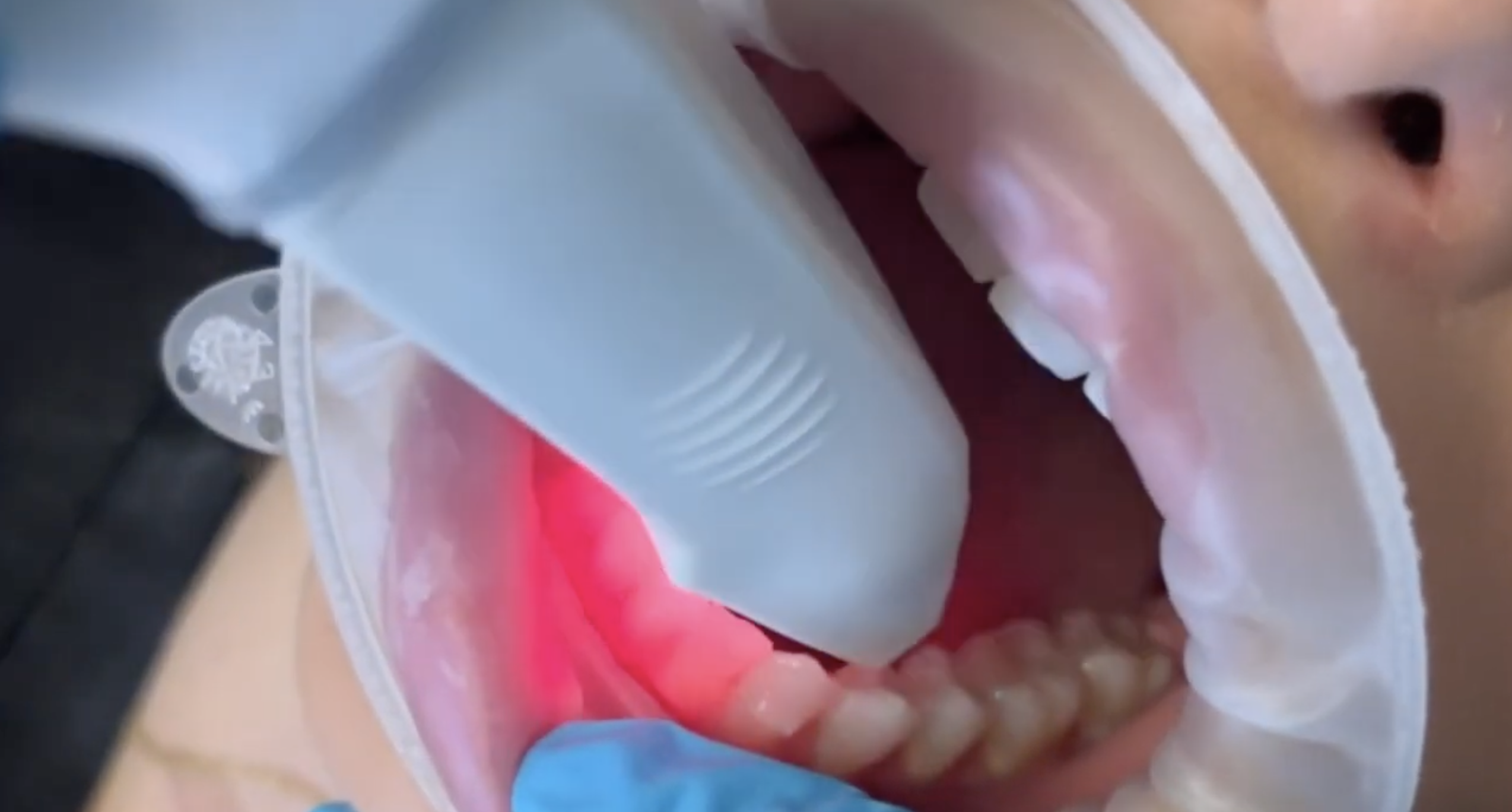 3D dental scan in progress at Chicago Dental Studio